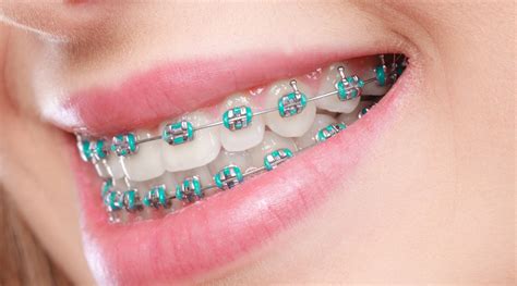 metal bracket orthodontics|traditional metal braces for adults.